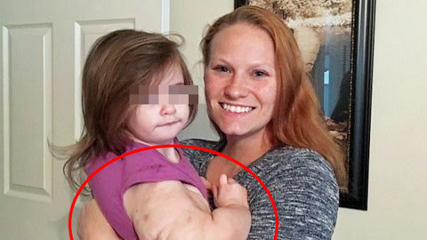 涨健识 女童患病手臂粗大似巨人