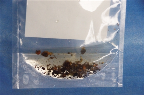 【公益进行时】10元查结石 周三名医会诊