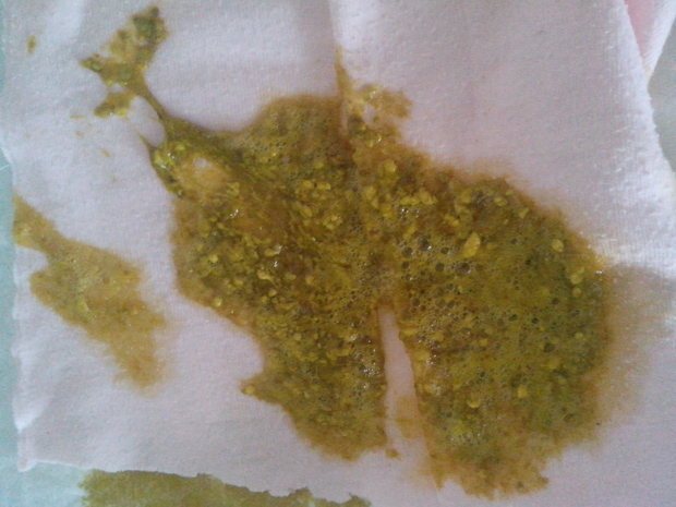 我家宝宝40天 拉这样的便便正常吗?