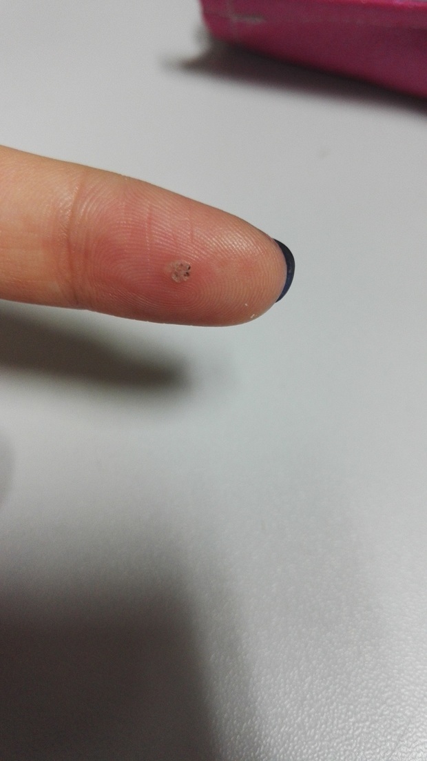 手指上,长了一个小肉瘤