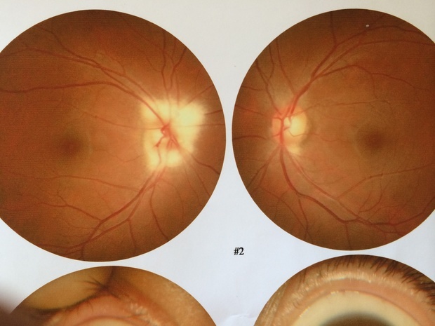 眼底彩照怎么看