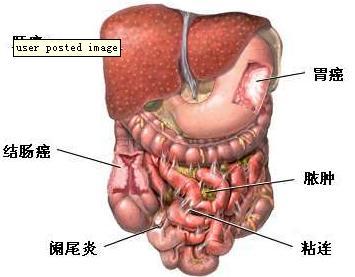 回盲部多发憩室图片