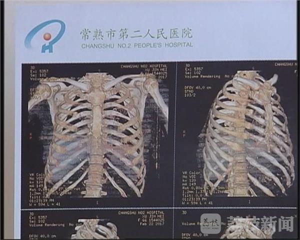 6旬老婦遭兒子毆打 11根肋骨斷裂左耳膜穿孔