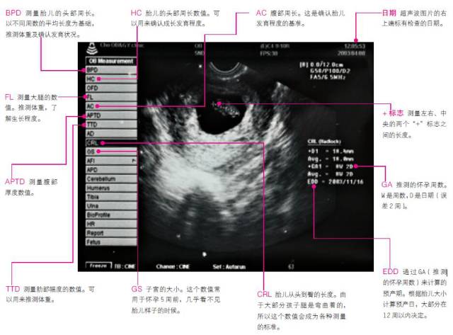 怀孕那么久了还不会看超声波图片 快来学习学习