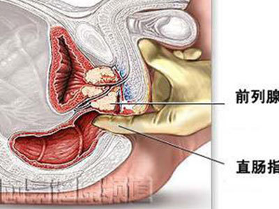 前列腺炎疼痛部位大图图片